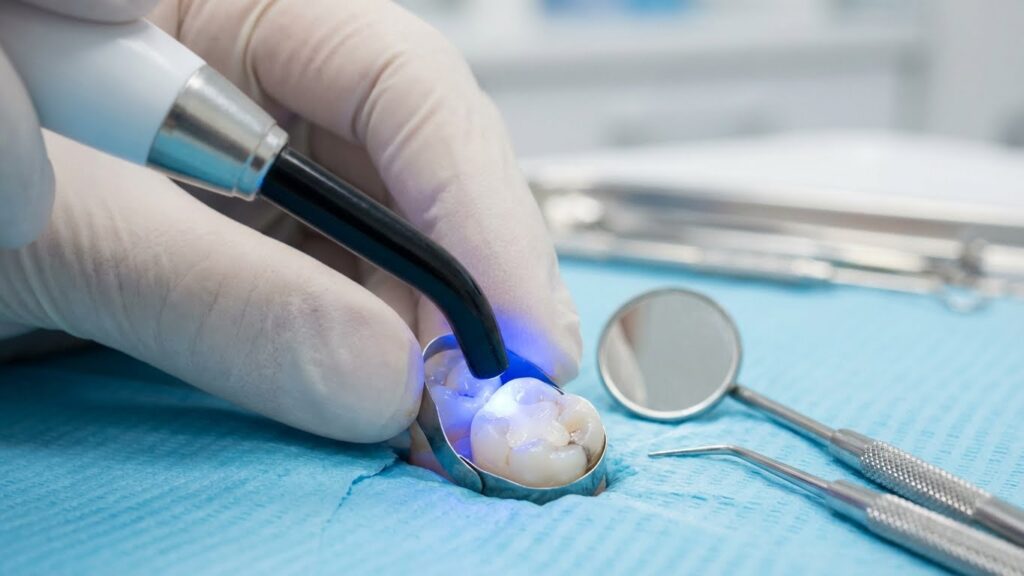 Dịch vụ Trám Răng tại Lái Thiêu