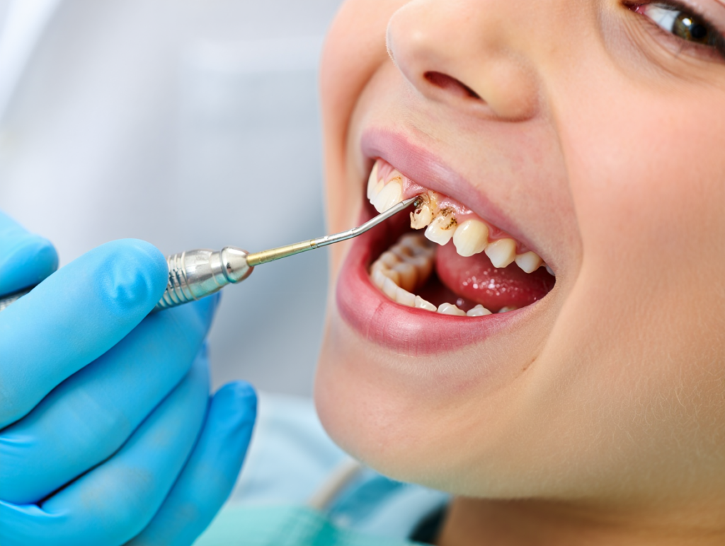 Điều Trị Viêm Nướu Nha Chu tại Lái Thiêu