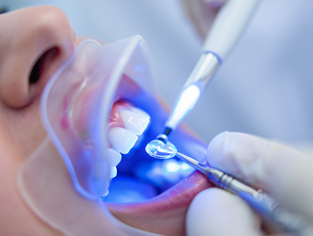 Đính Đá Răng tại Lái Thiêu Bình Dương