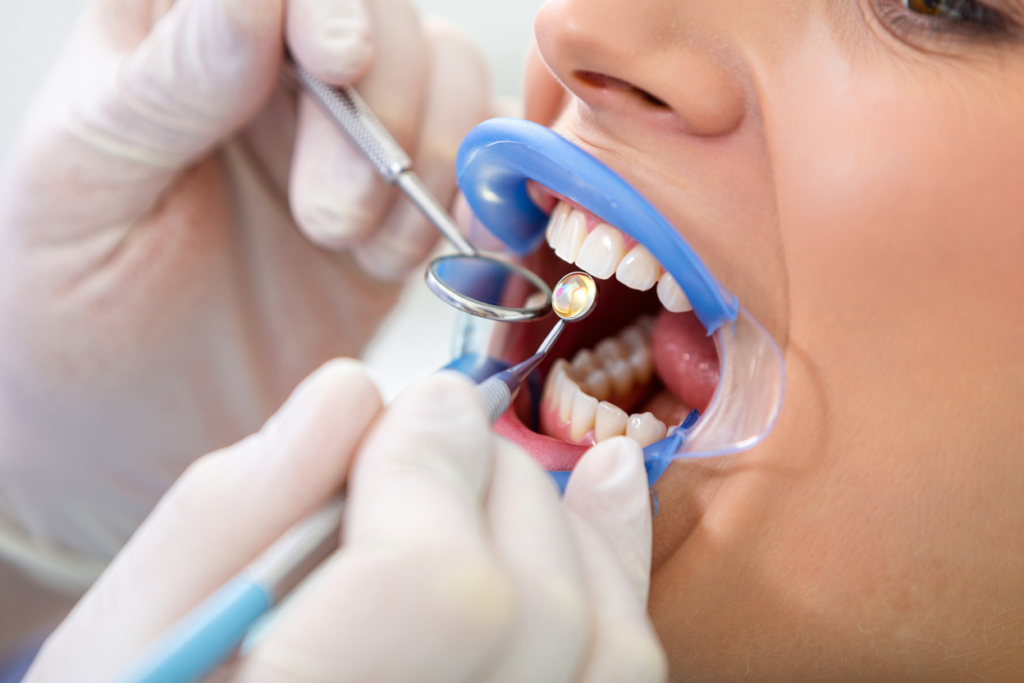 Đính Đá Răng tại Lái Thiêu Bình Dương